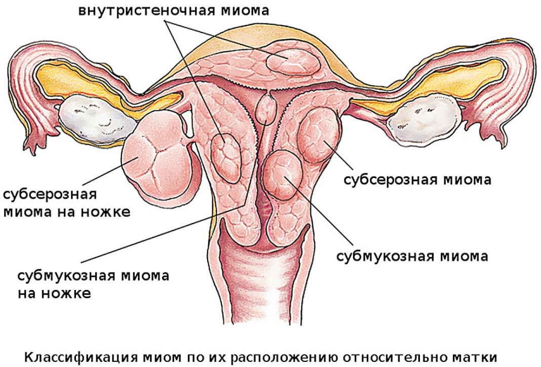 миома